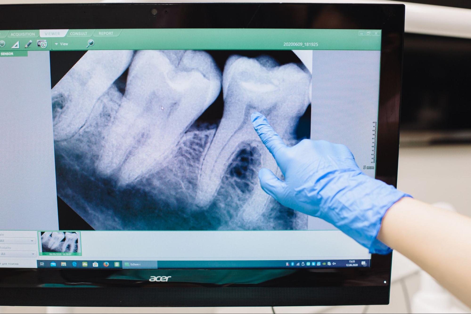 Gloved hand pointing to a dental x-ray of molars and their roots displayed on a computer monitor