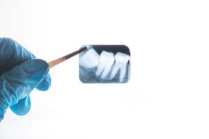 Gloved hand holding a small dental x-ray film of teeth with metal tweezers against a white background